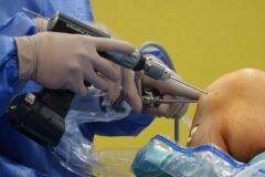 Cirurgia do joelho: quando ela é indicada e como funciona o processo de recuperação