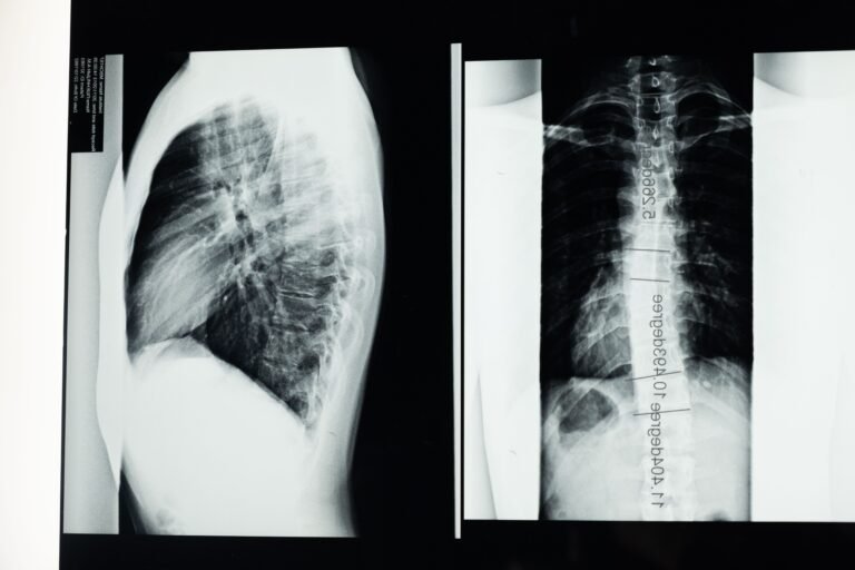 Esporão de calcâneo: entenda o que é essa protuberância no calcanhar